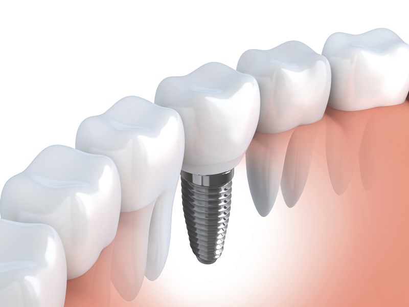 4 Common Misconceptions Regarding Partial Denture Implants in Brisbane - Bryn Fest